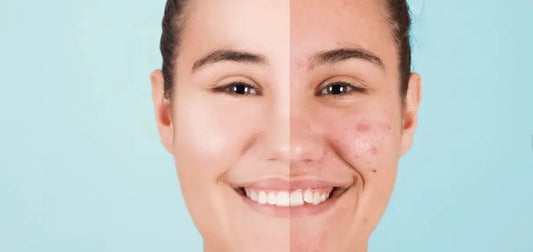 How-to-prevent-acne CLAYER- green clay - healing clay - bentonite clay