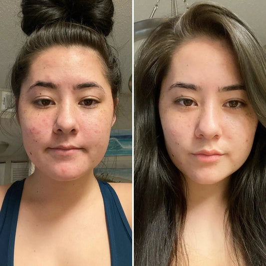 Is-clay-mask-good-for-acne CLAYER- green clay - healing clay - bentonite clay