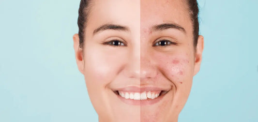 Come prevenire l'acne CLAYER - argilla verde - argilla curativa - argilla bentonitica